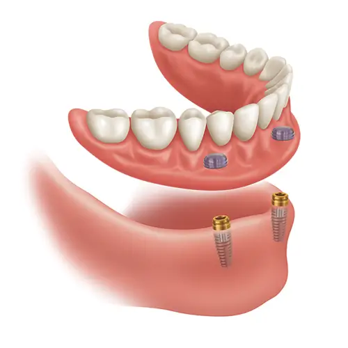 Illustration of a full lower arch of teeth seated on four dental implants